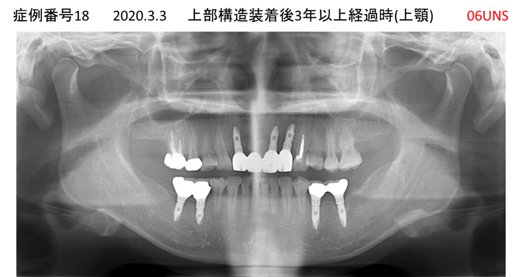インプラント治療後