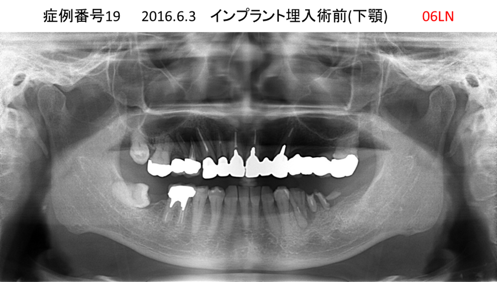 インプラント治療前