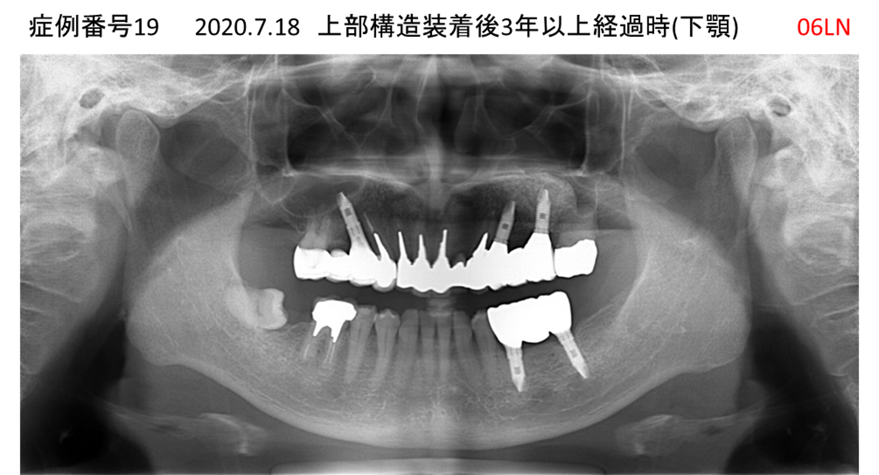 インプラント治療後