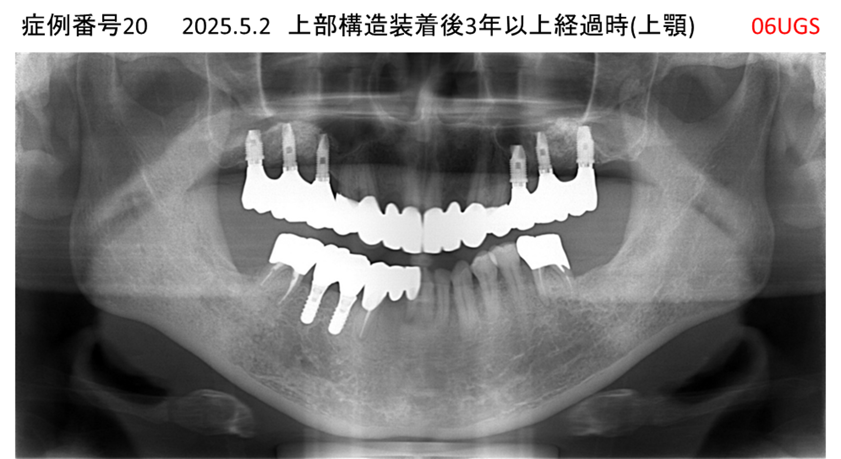 インプラント治療後