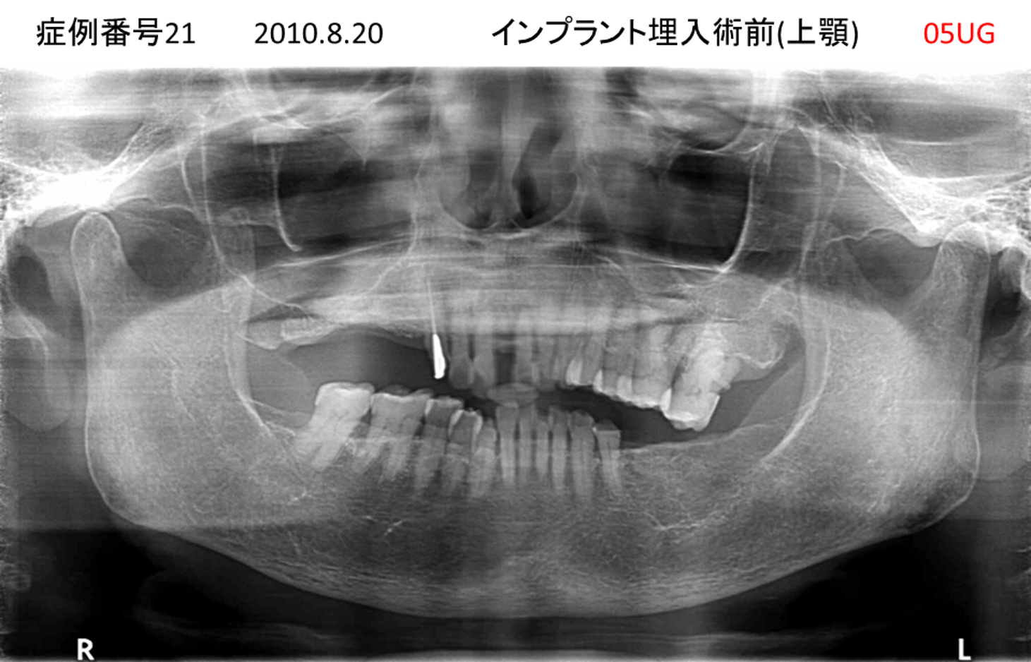 インプラント治療前