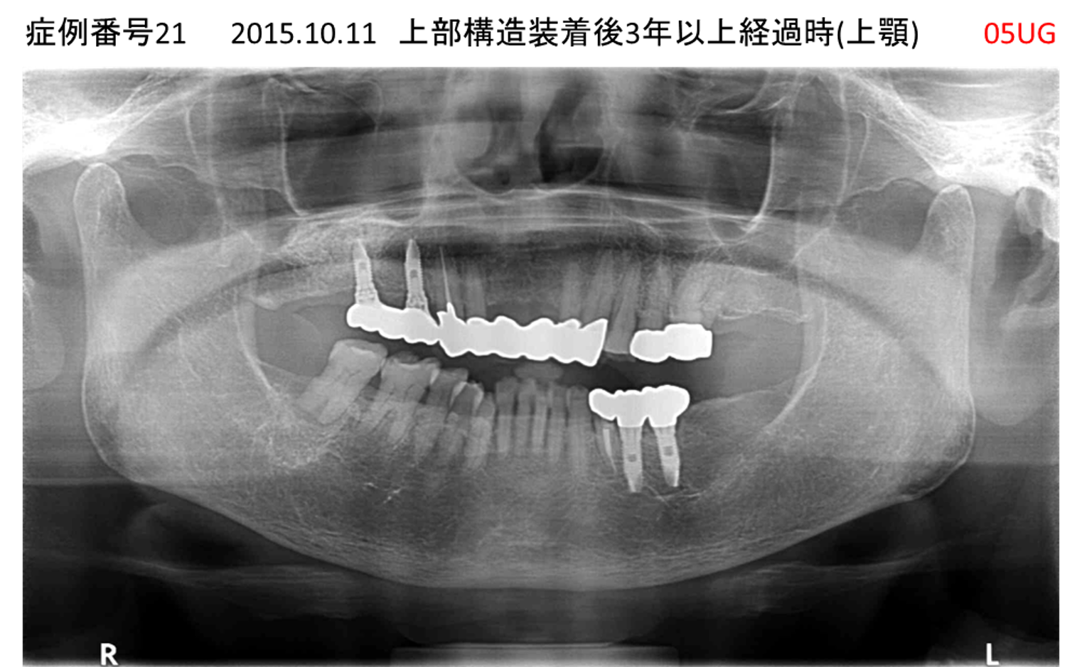 インプラント治療後