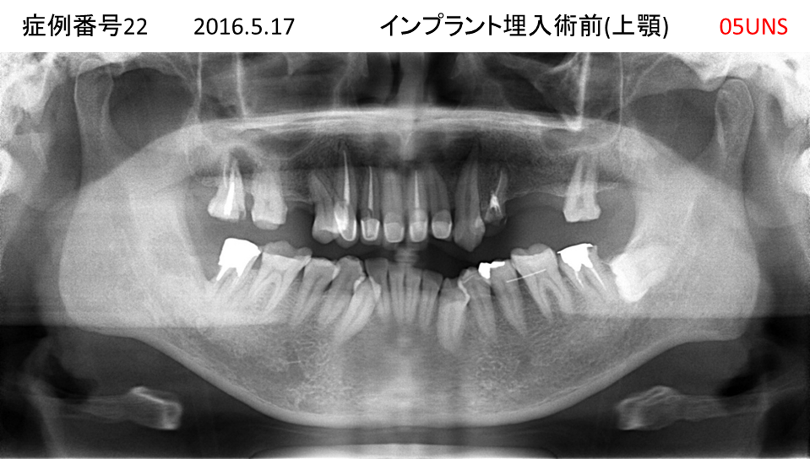 インプラント治療前