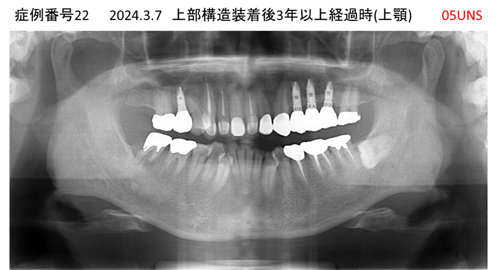 インプラント治療後