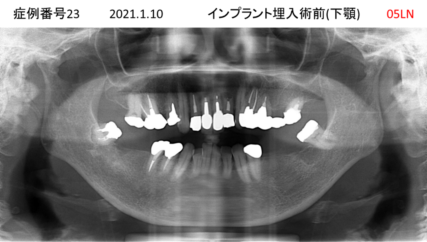 インプラント治療前