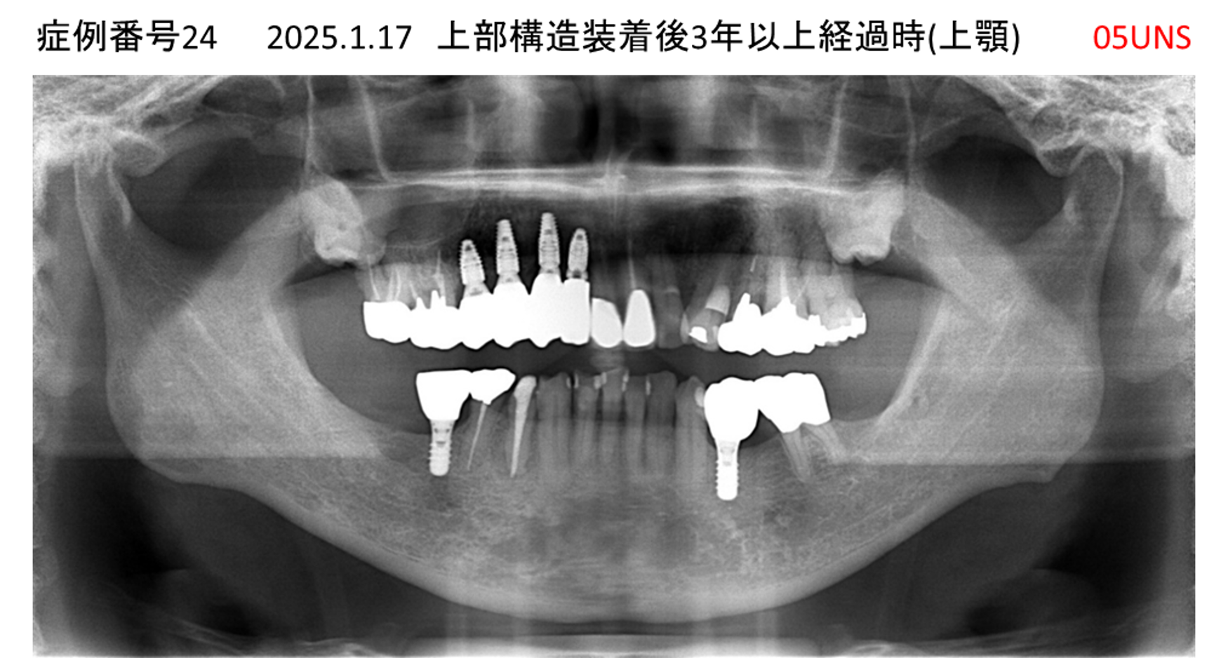 インプラント治療後