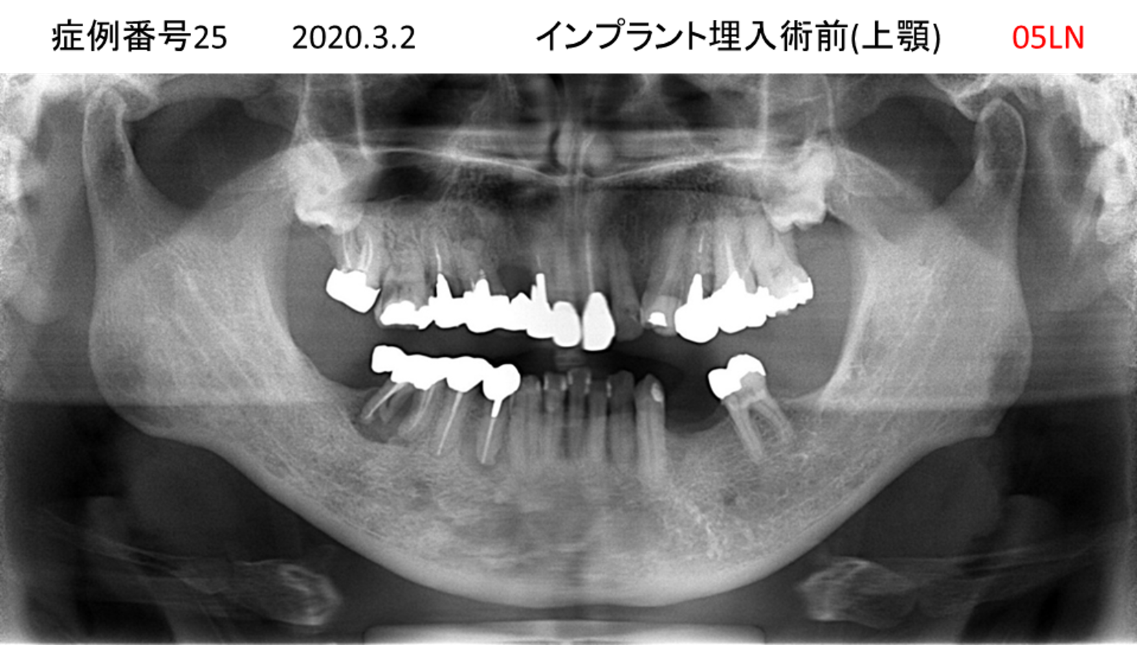 インプラント治療前