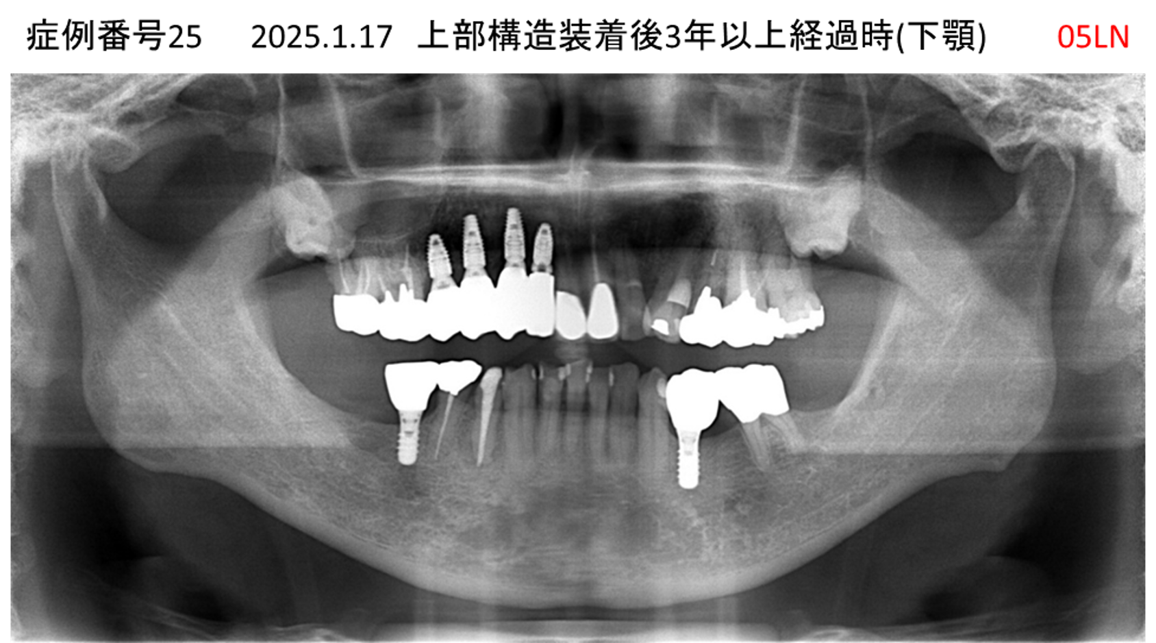 インプラント治療後