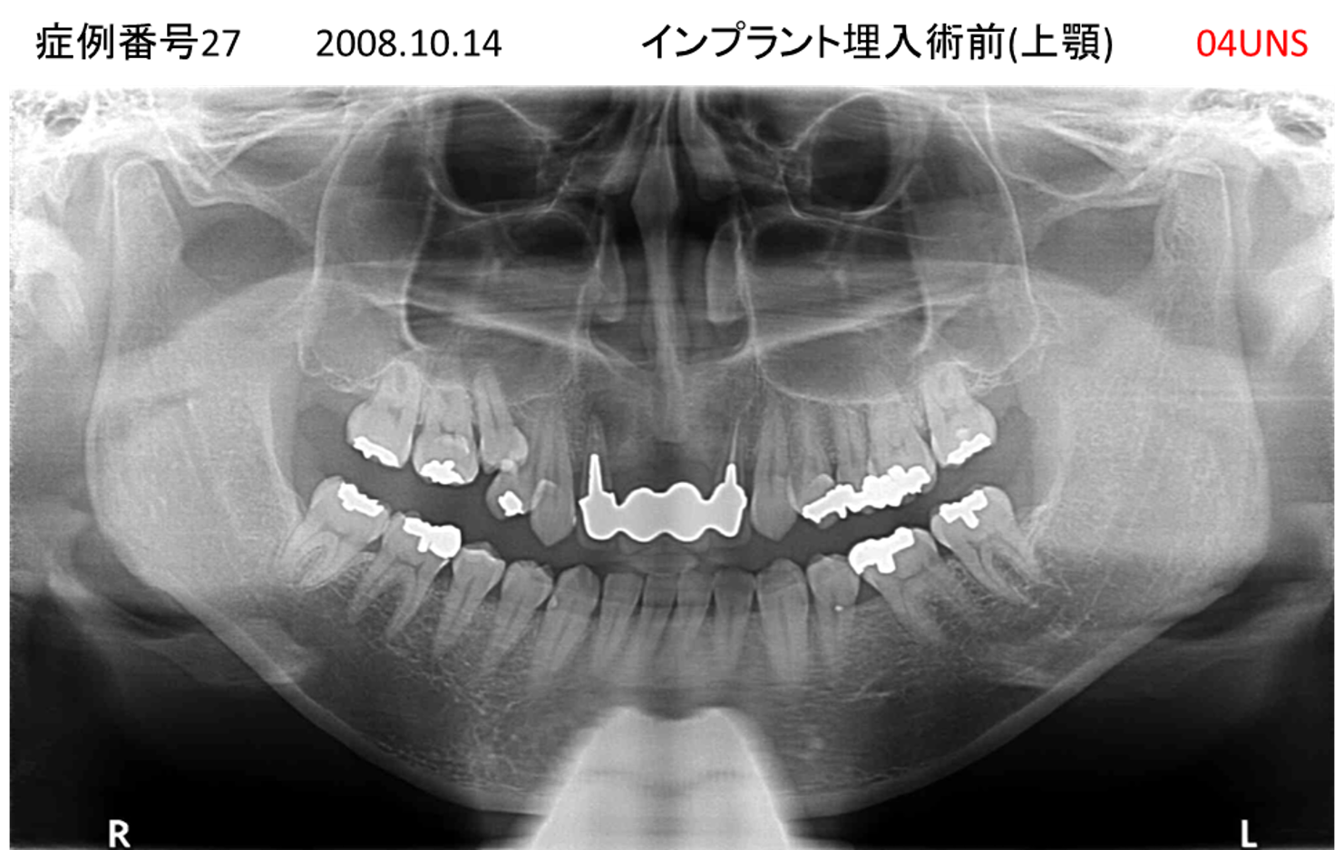インプラント治療前