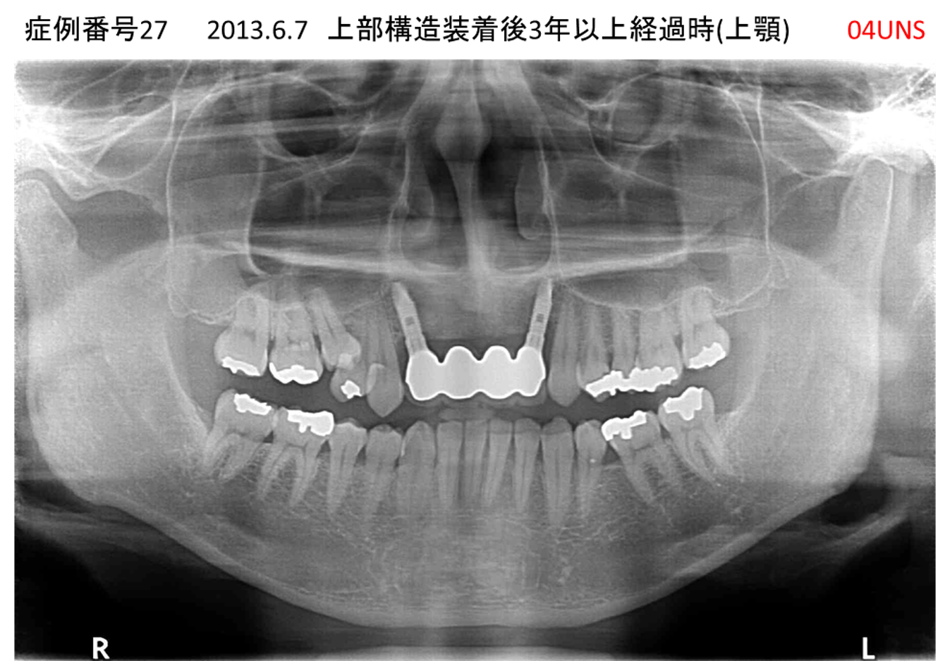 インプラント治療後