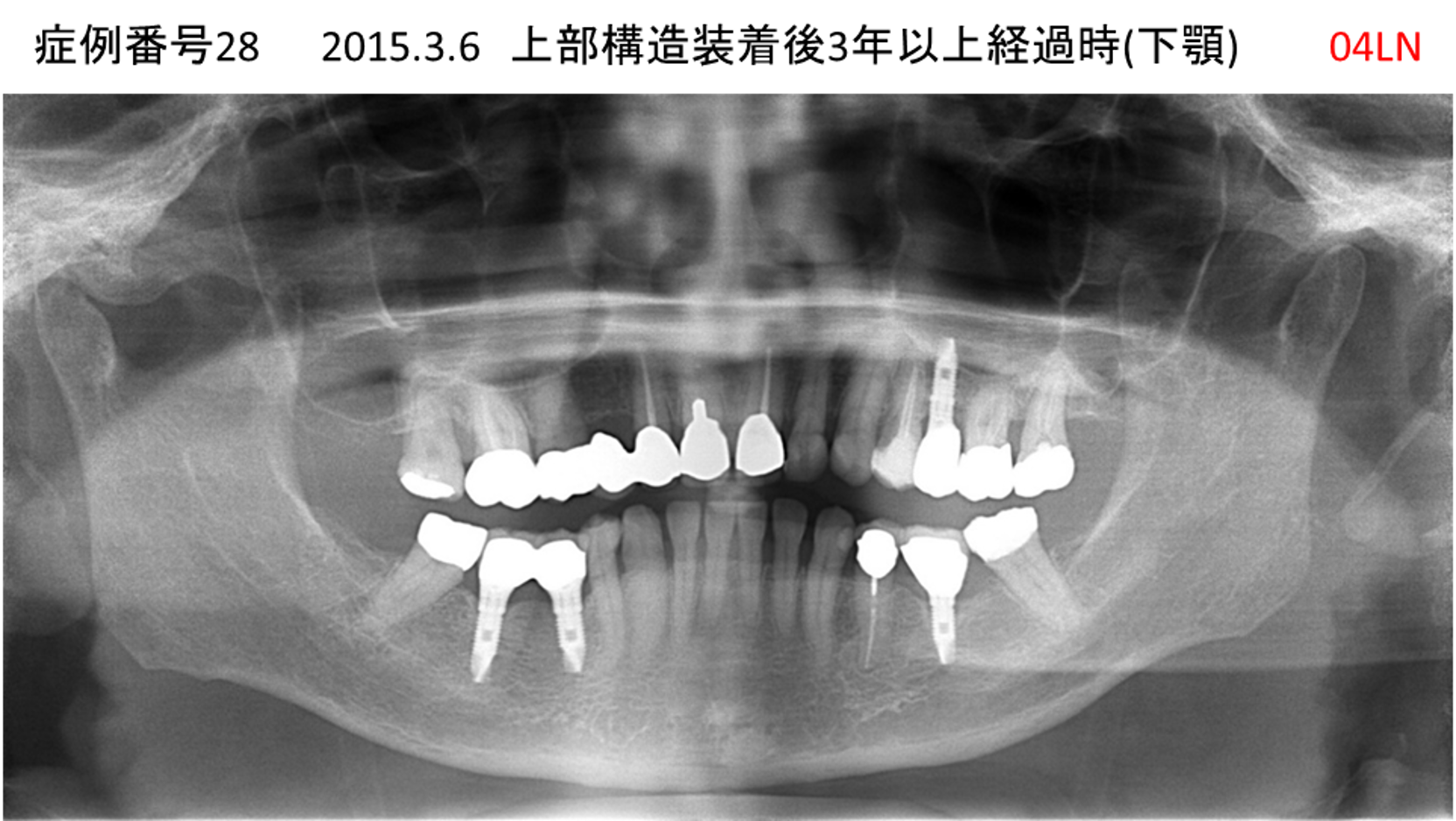インプラント治療後