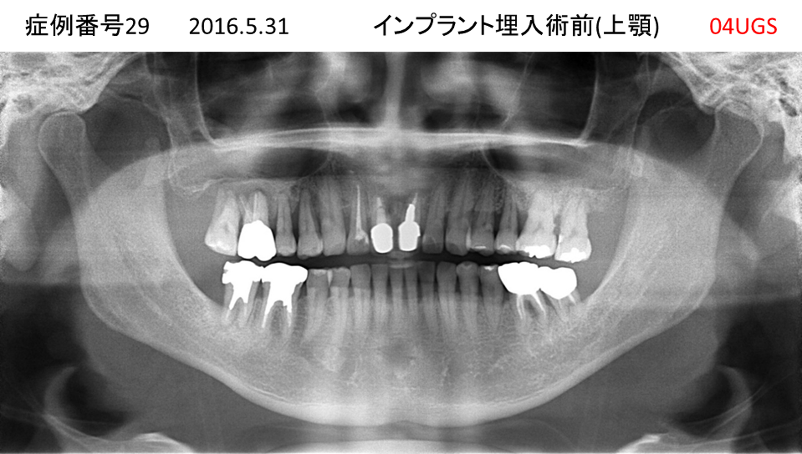 インプラント治療前