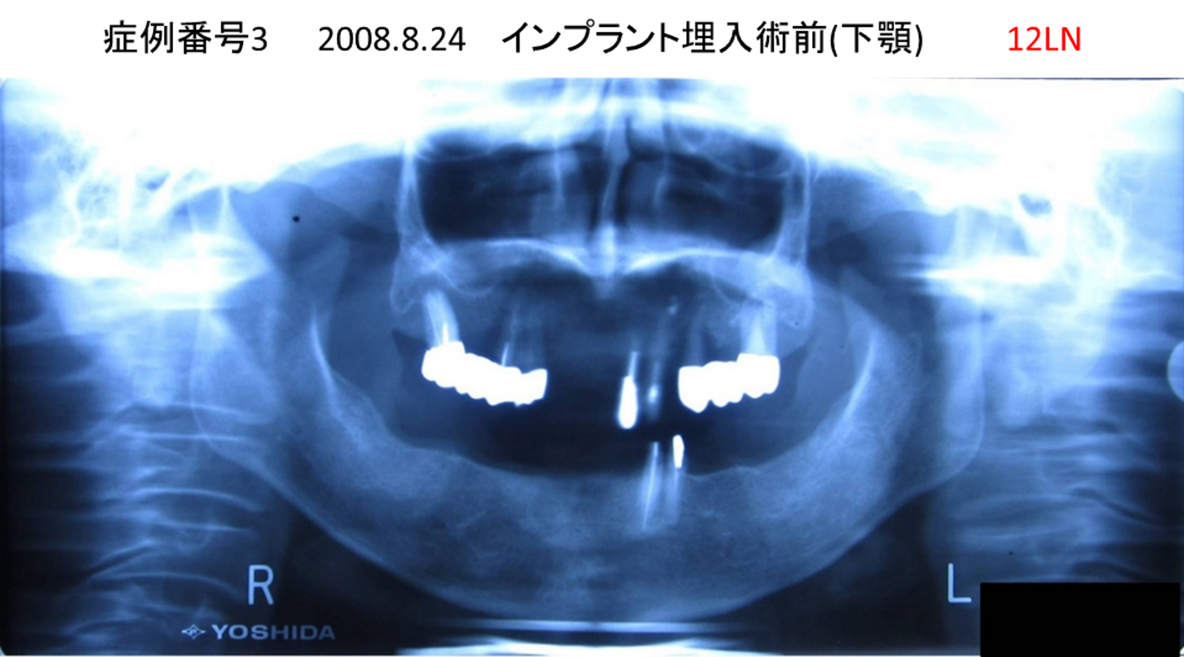 インプラント治療前