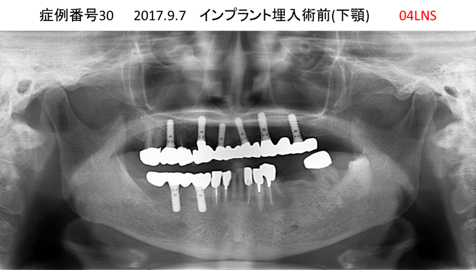 インプラント治療前