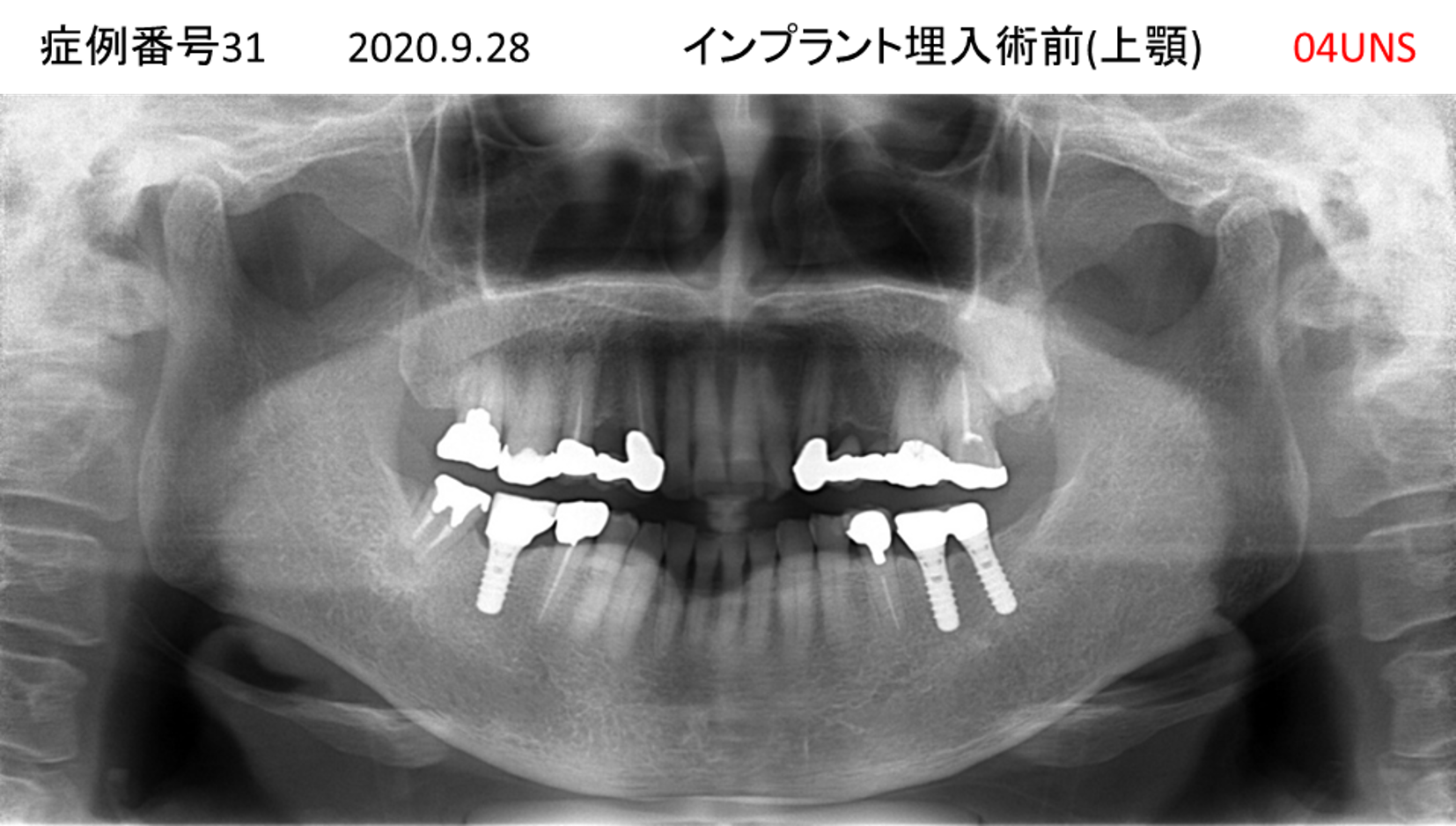 インプラント治療前