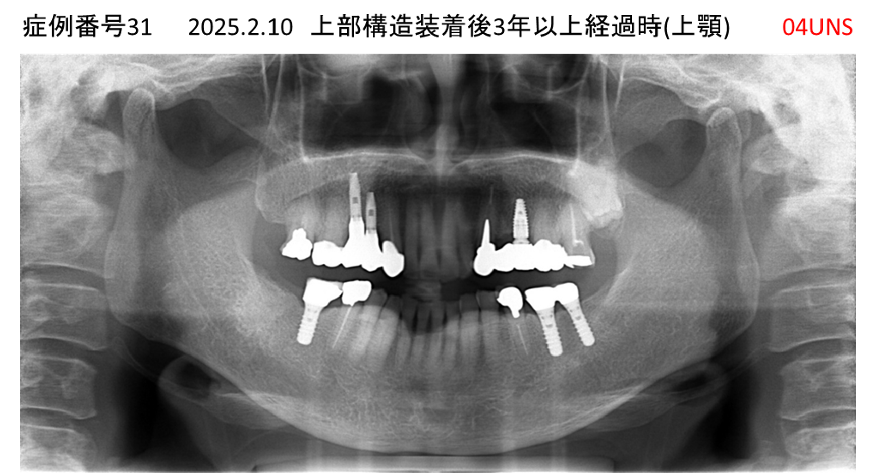 インプラント治療後