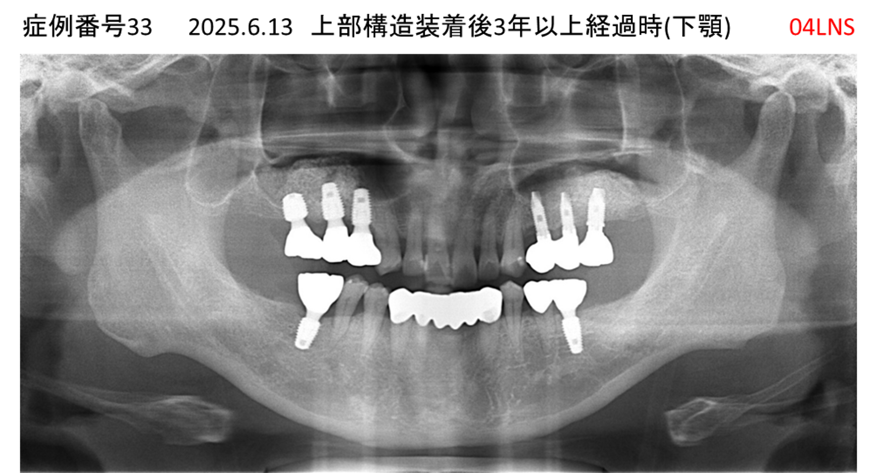 インプラント治療後