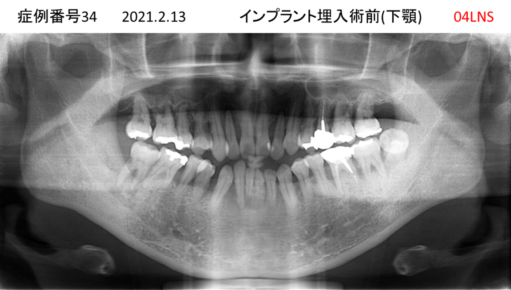 インプラント治療前
