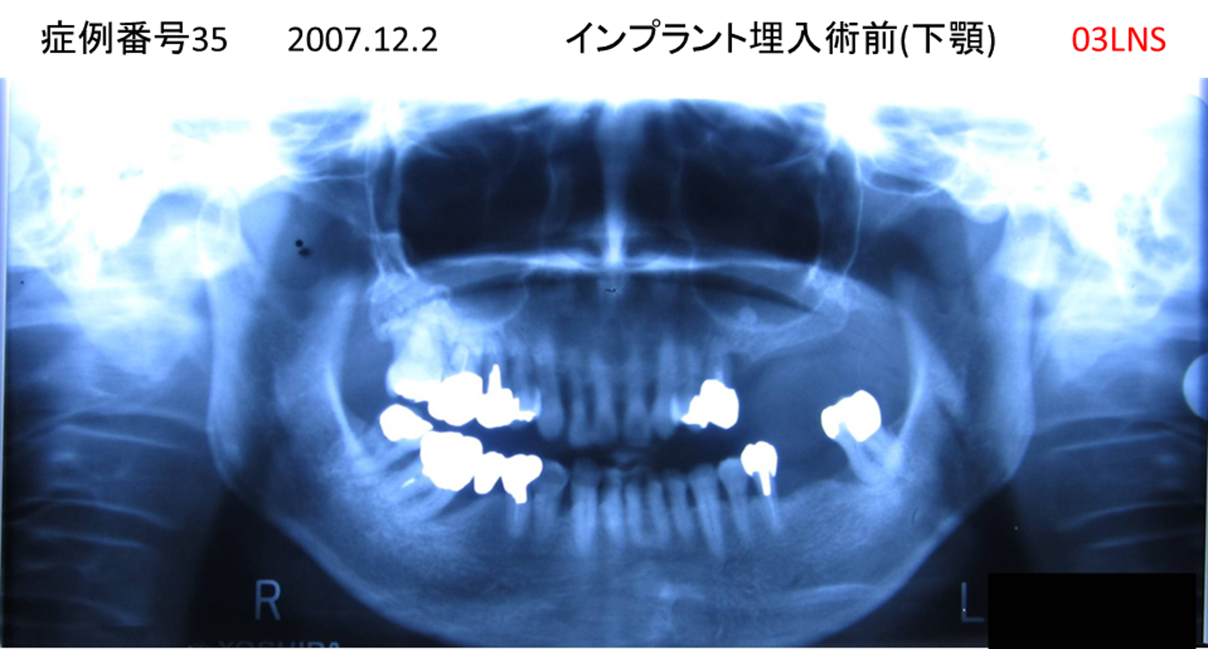 インプラント治療前