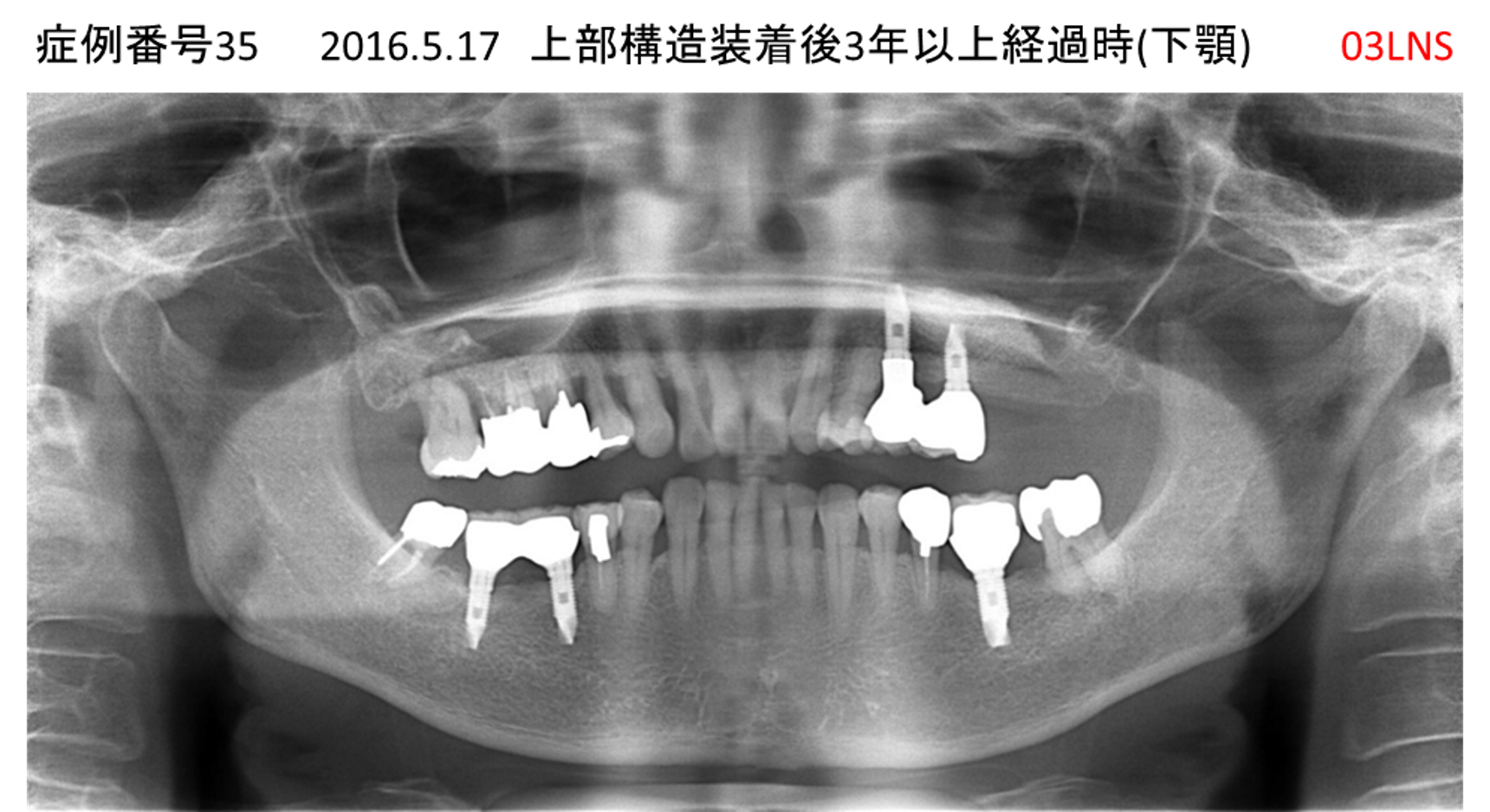 インプラント治療後