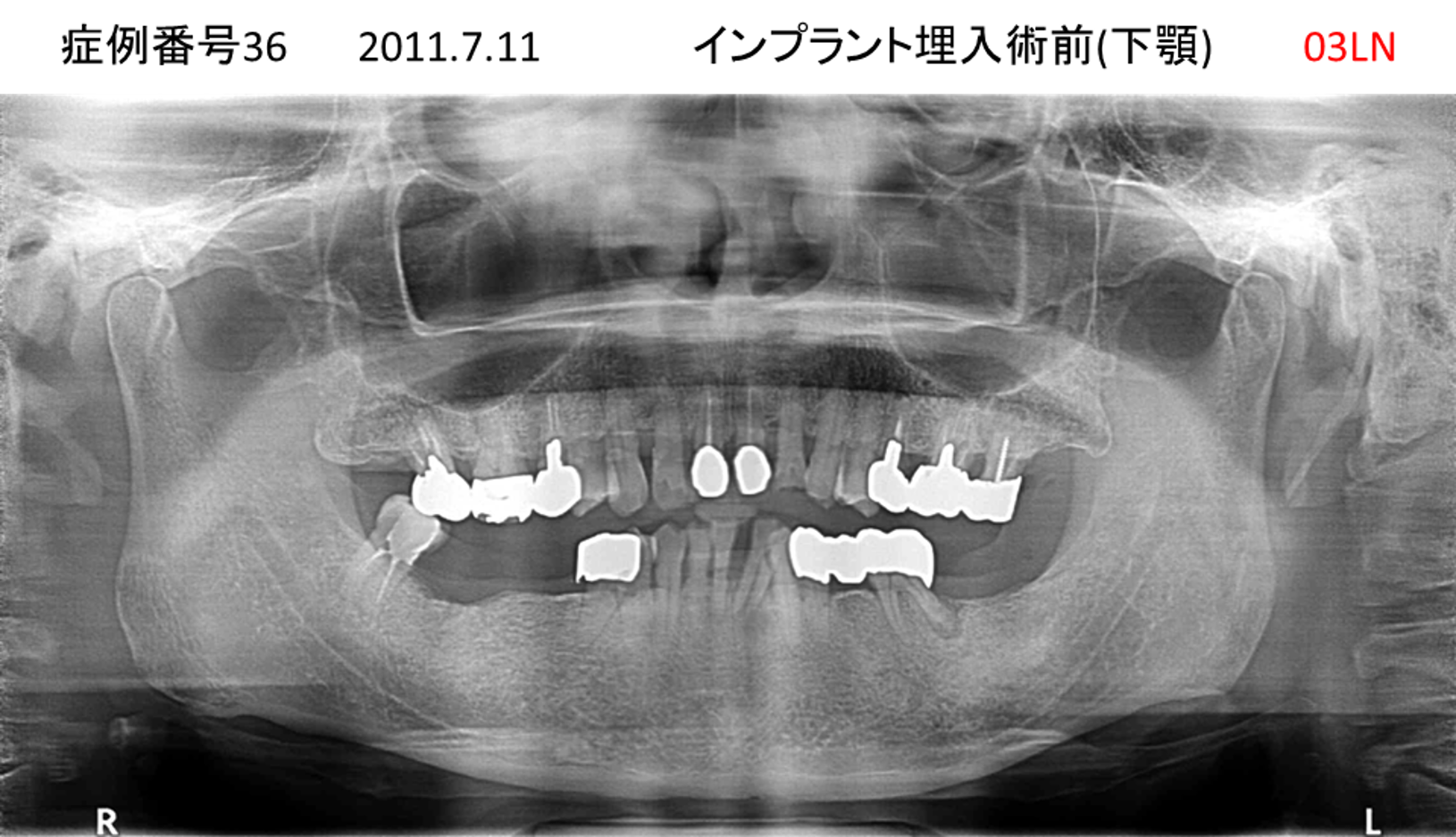 インプラント治療前