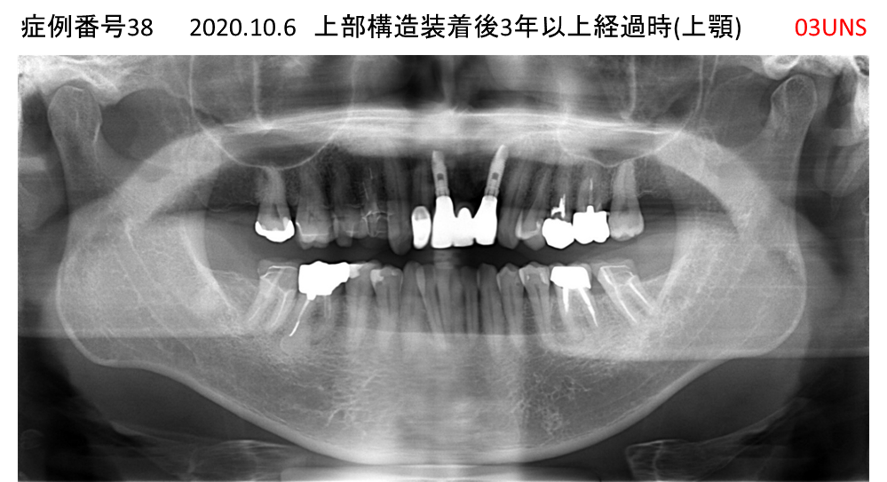インプラント治療後