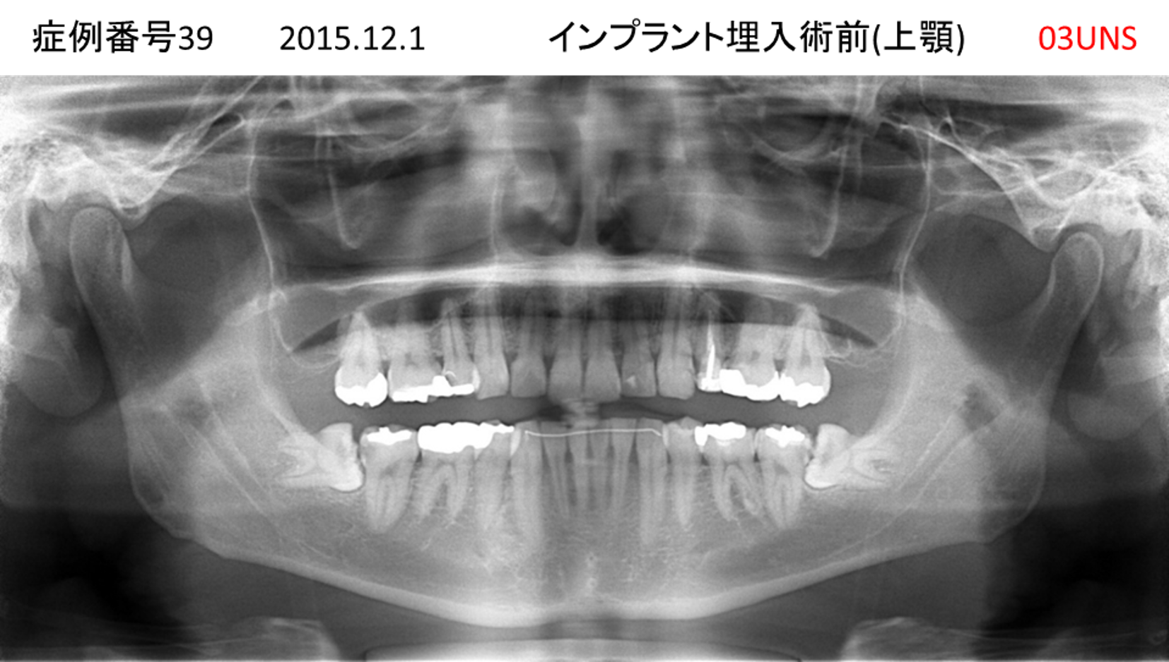 インプラント治療前