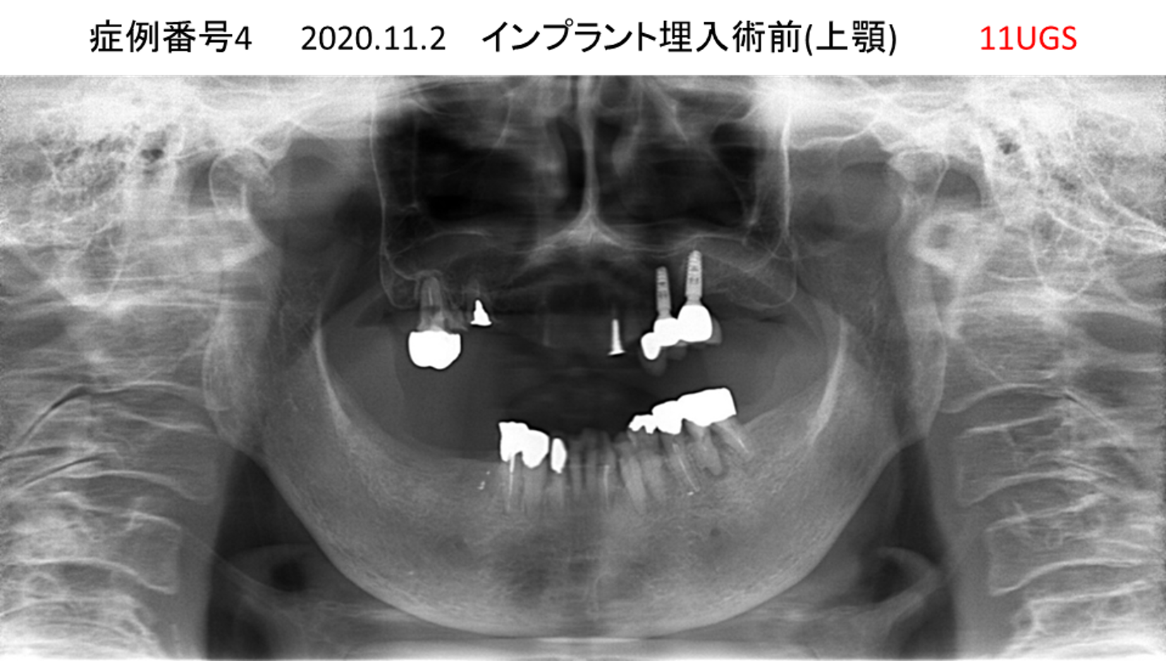 インプラント治療前