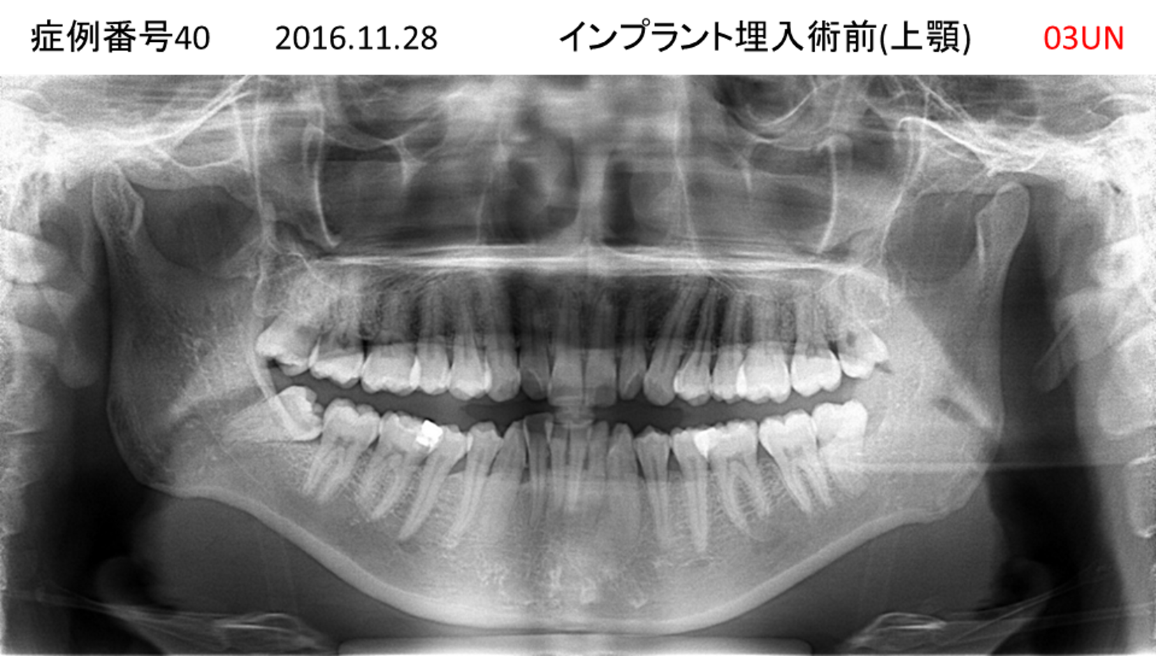 インプラント治療前