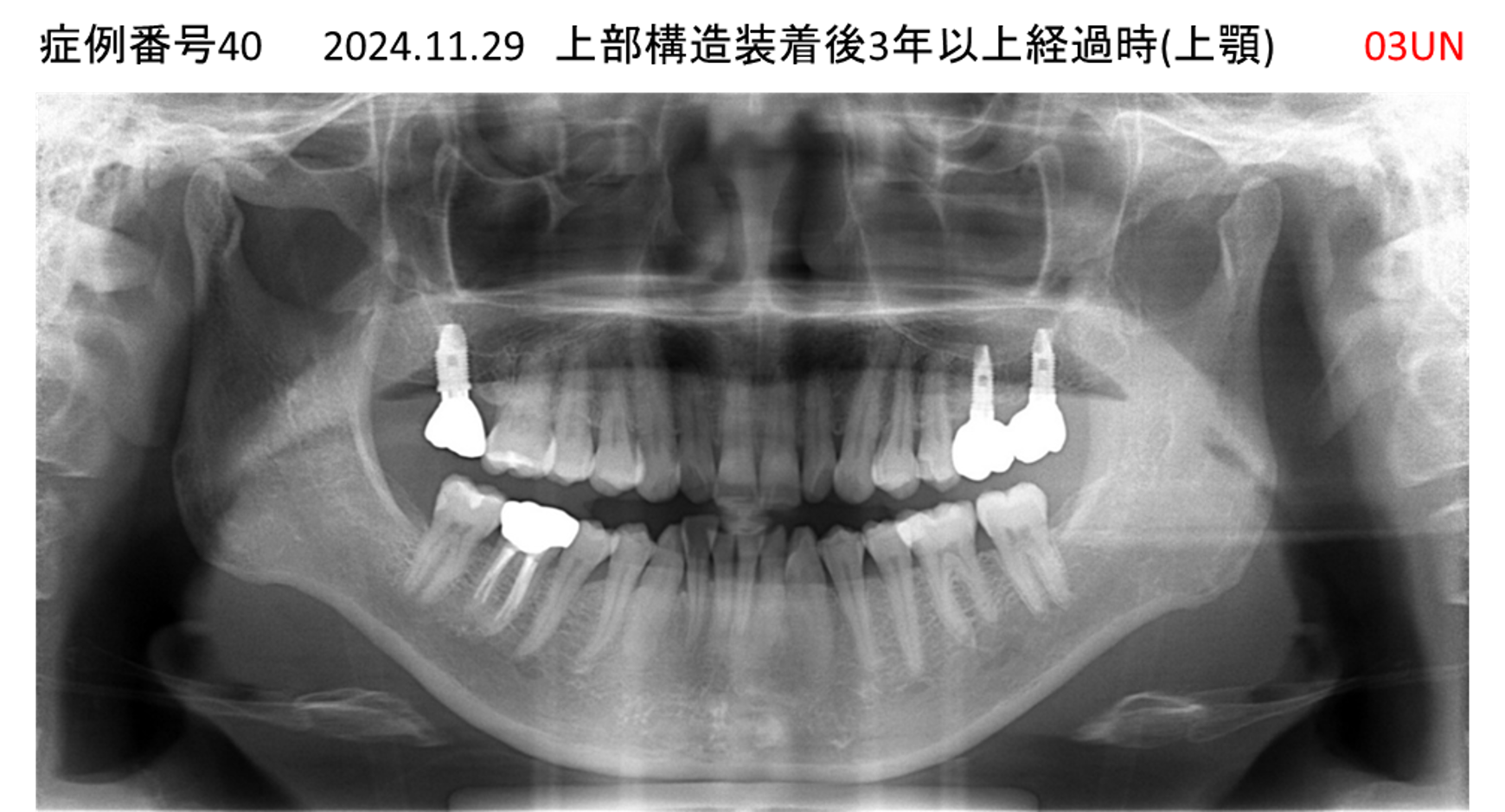 インプラント治療後