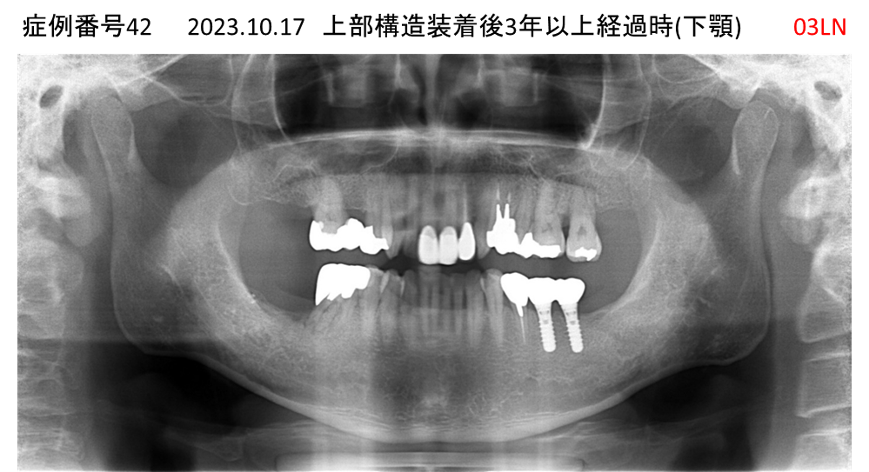 インプラント治療後