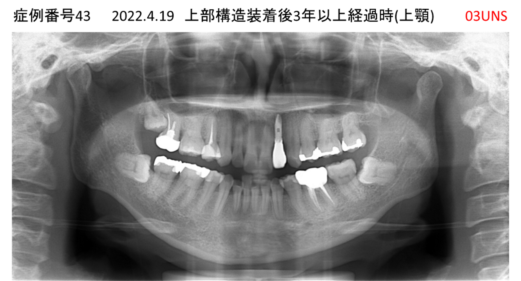 インプラント治療後