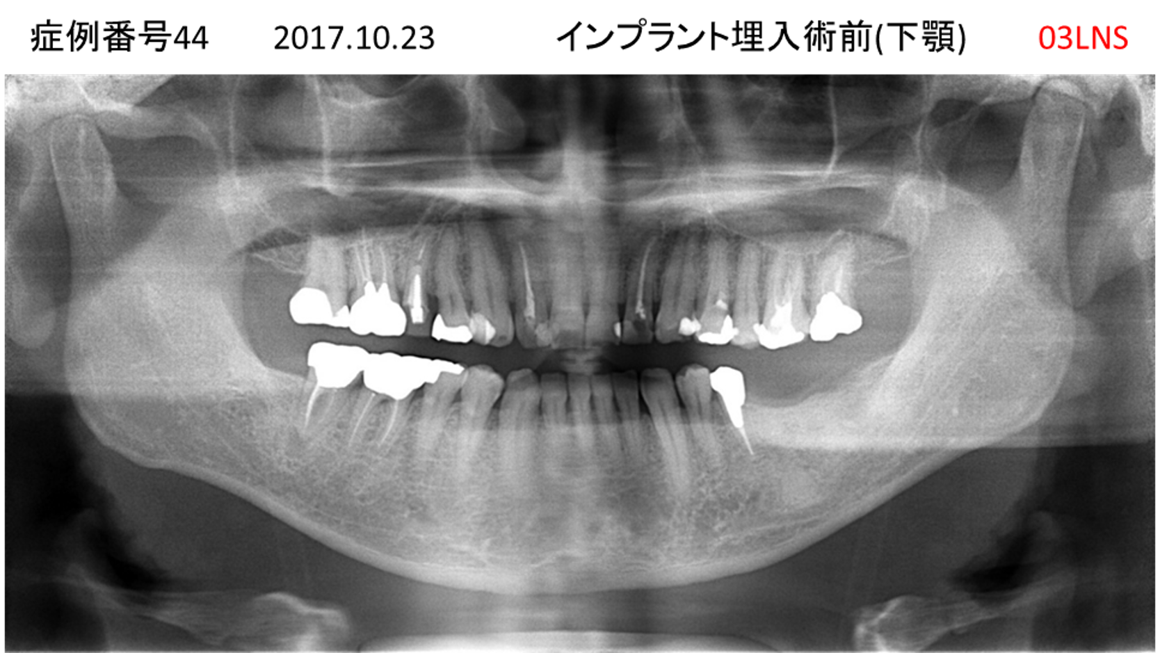 インプラント治療前