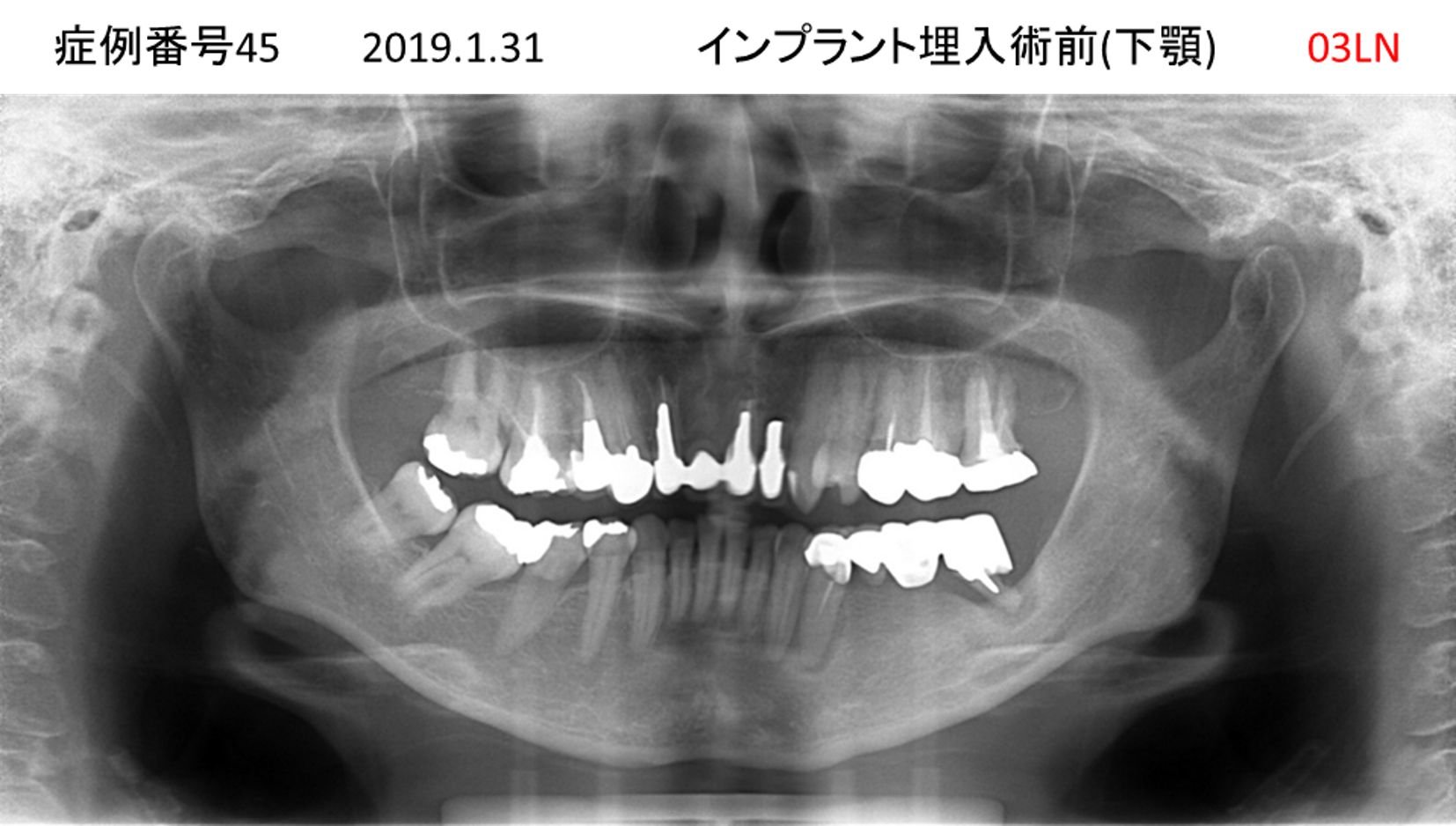 インプラント治療前