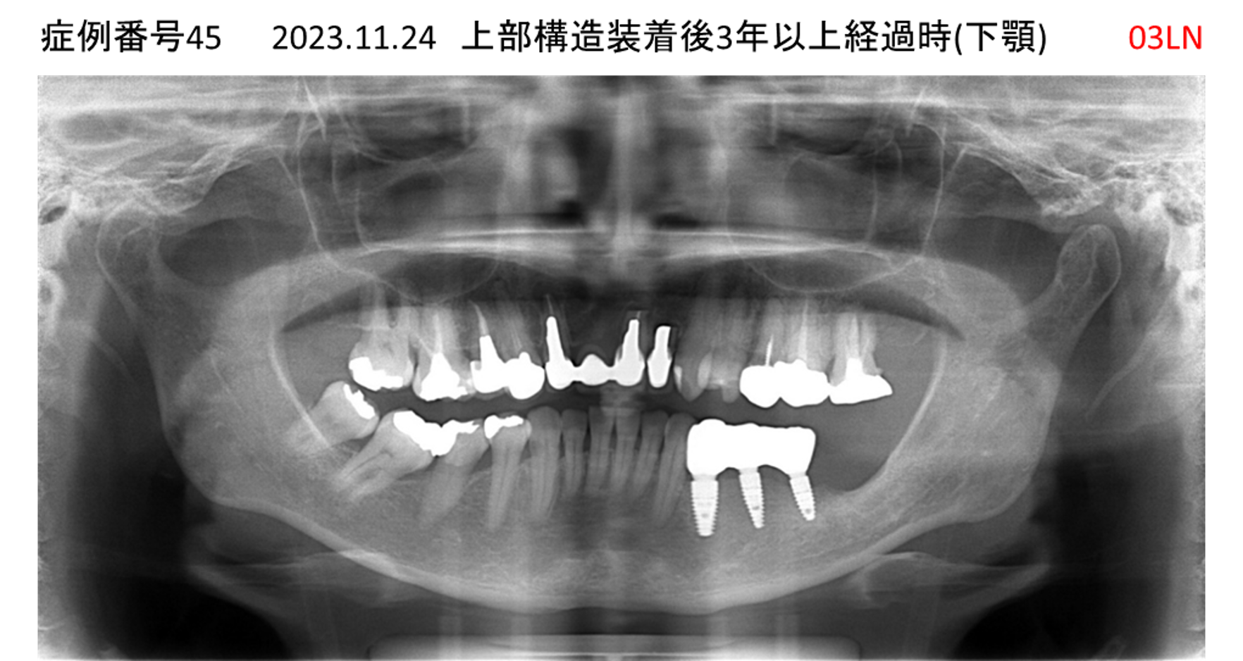 インプラント治療後