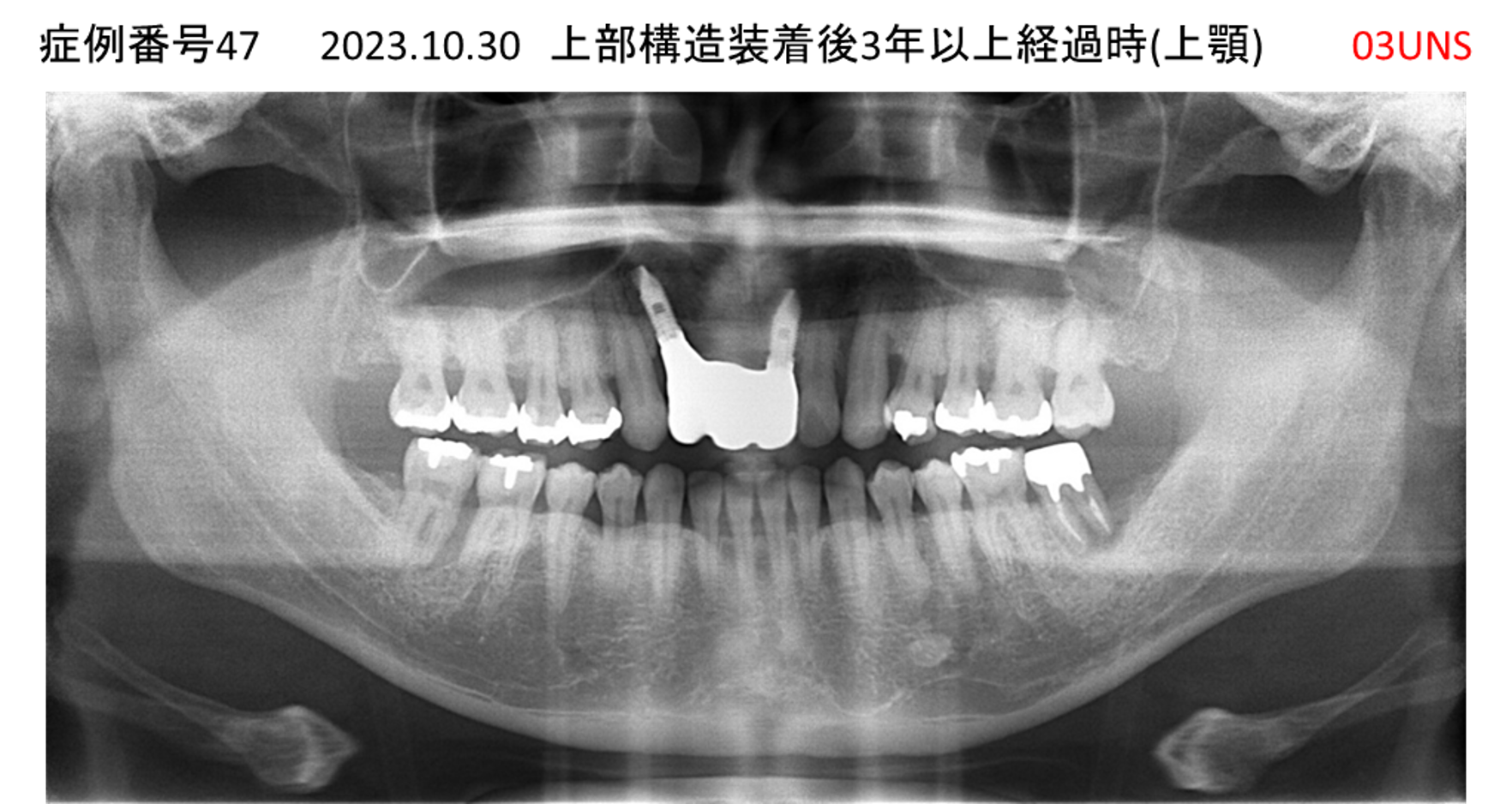 インプラント治療後