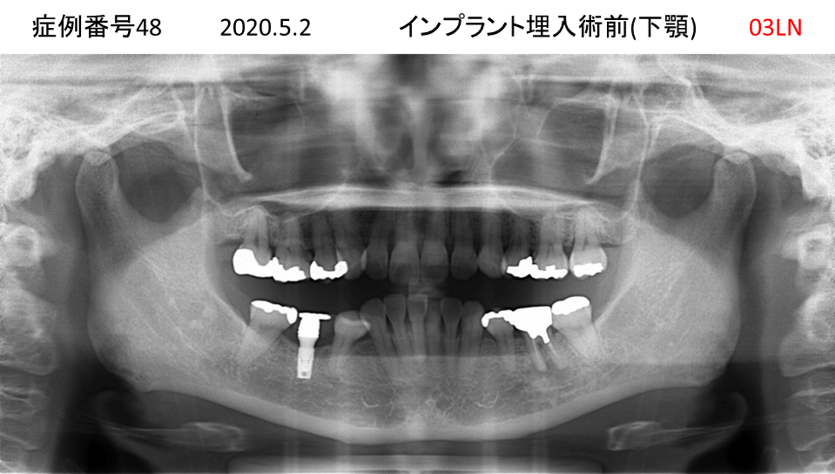 インプラント治療前
