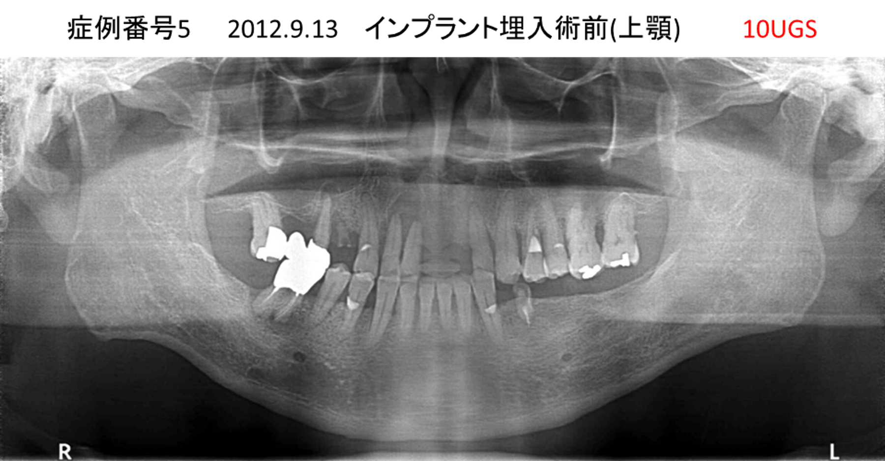 インプラント治療前