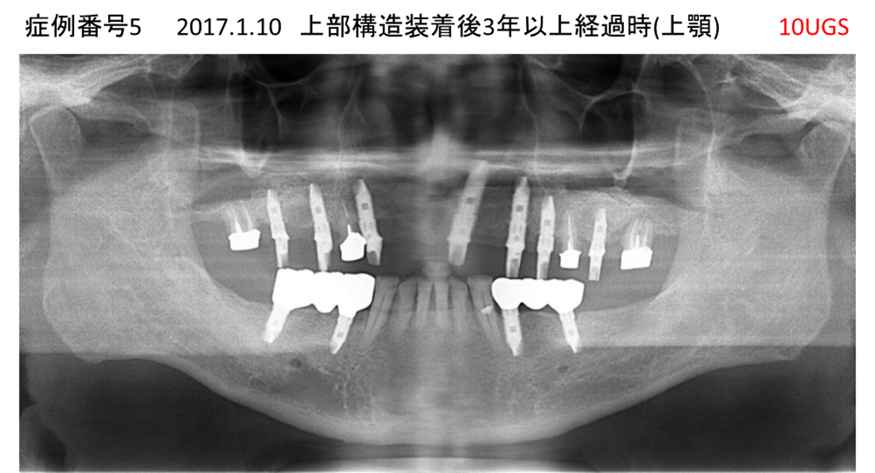 インプラント治療後