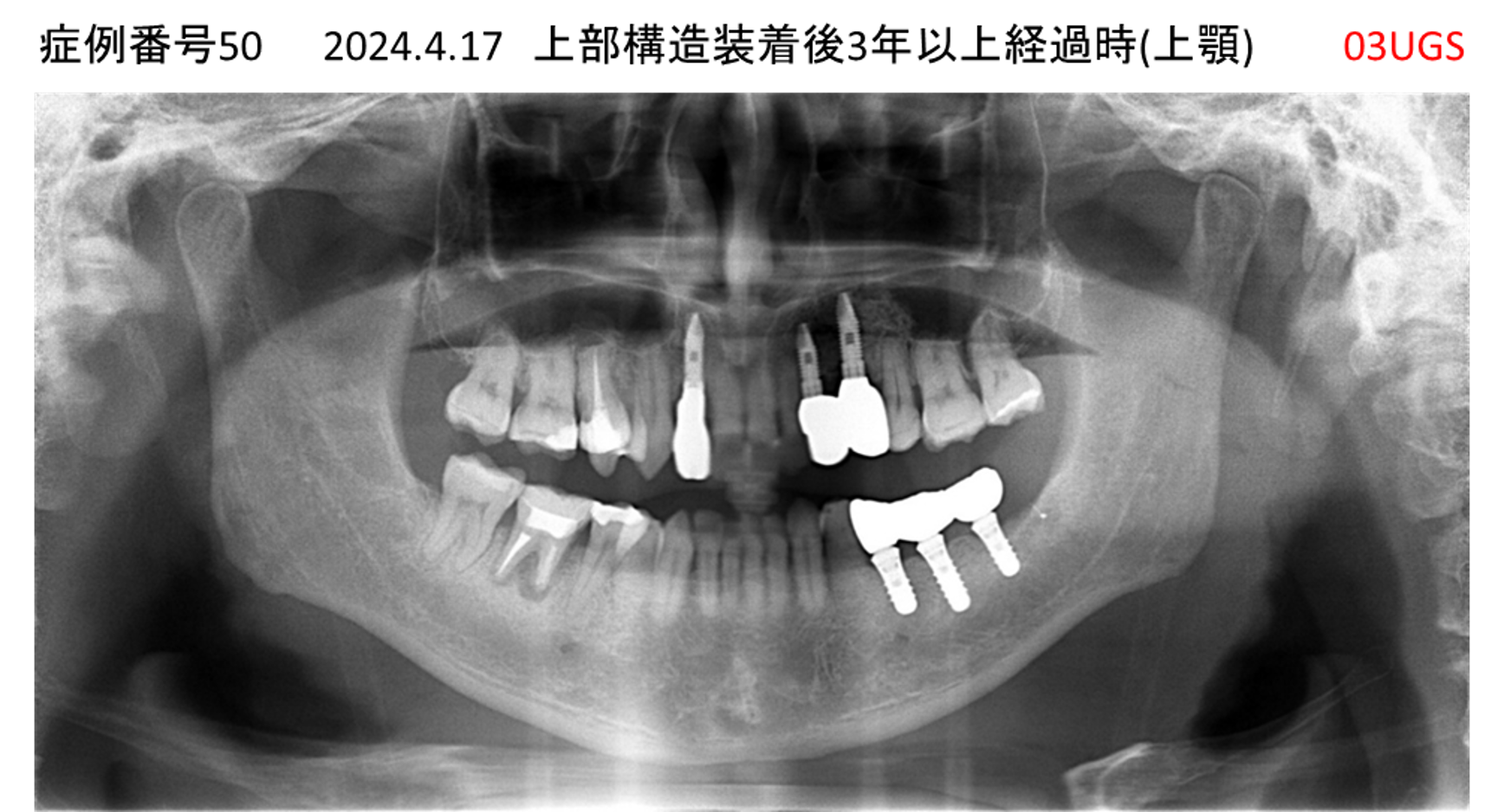インプラント治療後