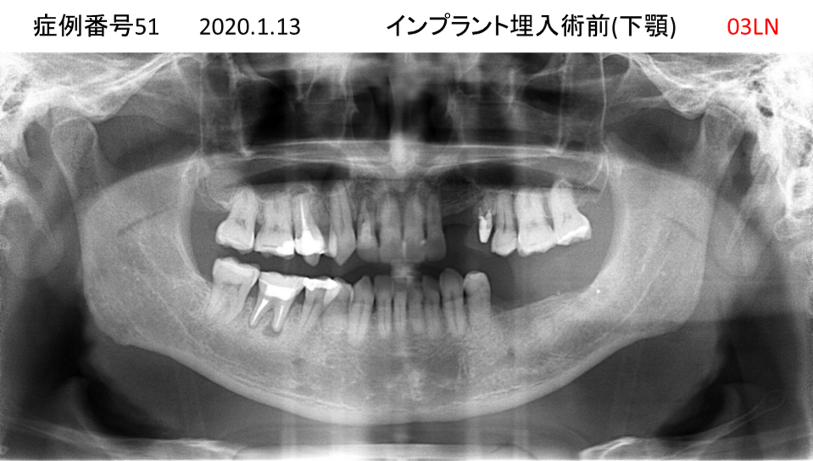 インプラント治療前