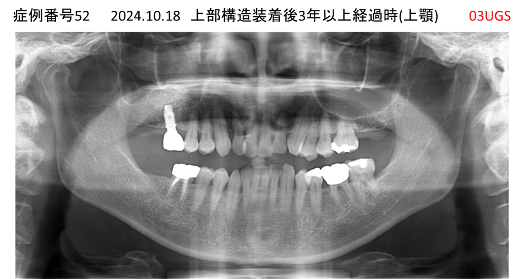 インプラント治療後