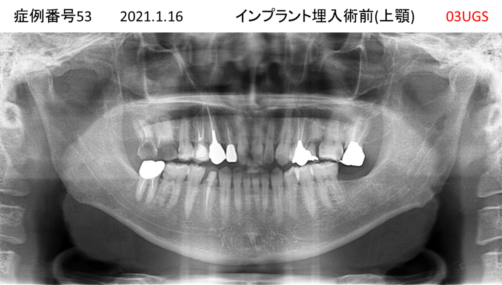 インプラント治療前