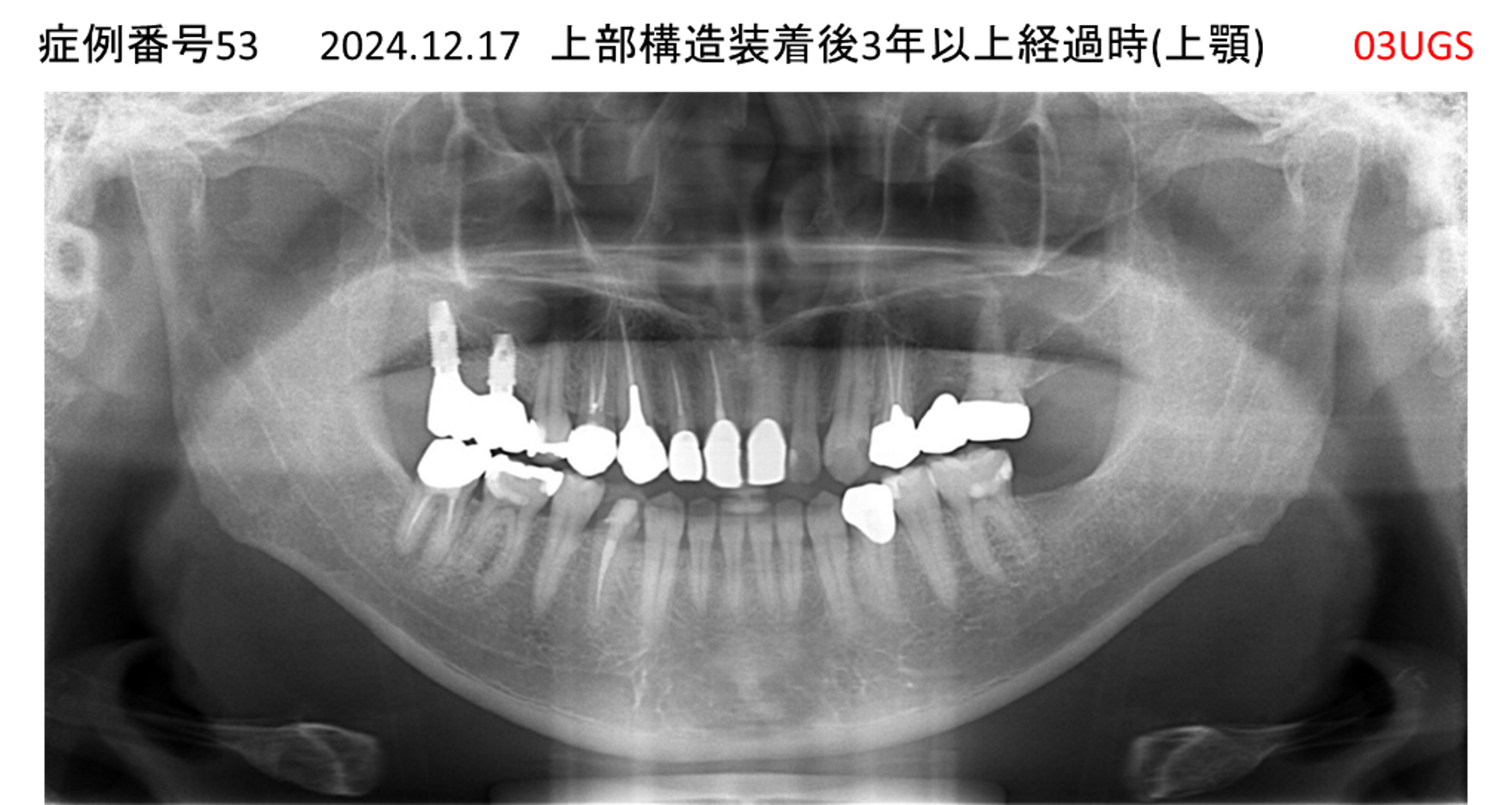 インプラント治療後