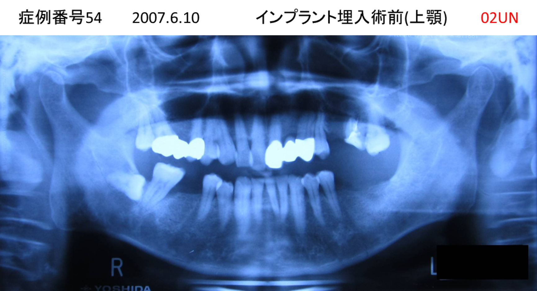 インプラント治療前