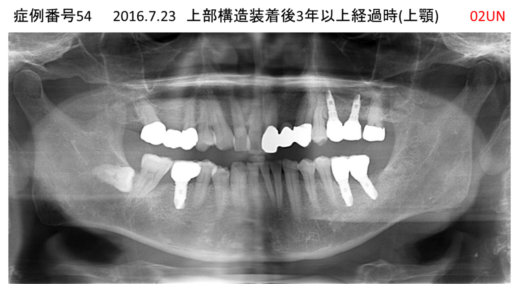 インプラント治療後
