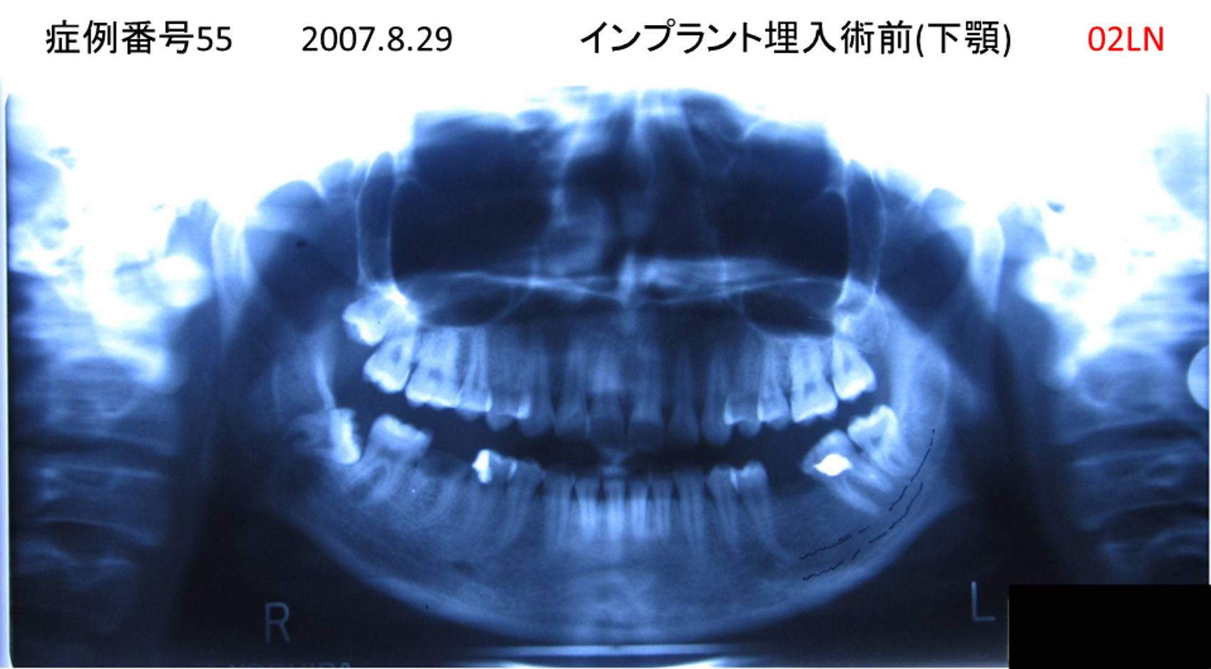 インプラント治療前