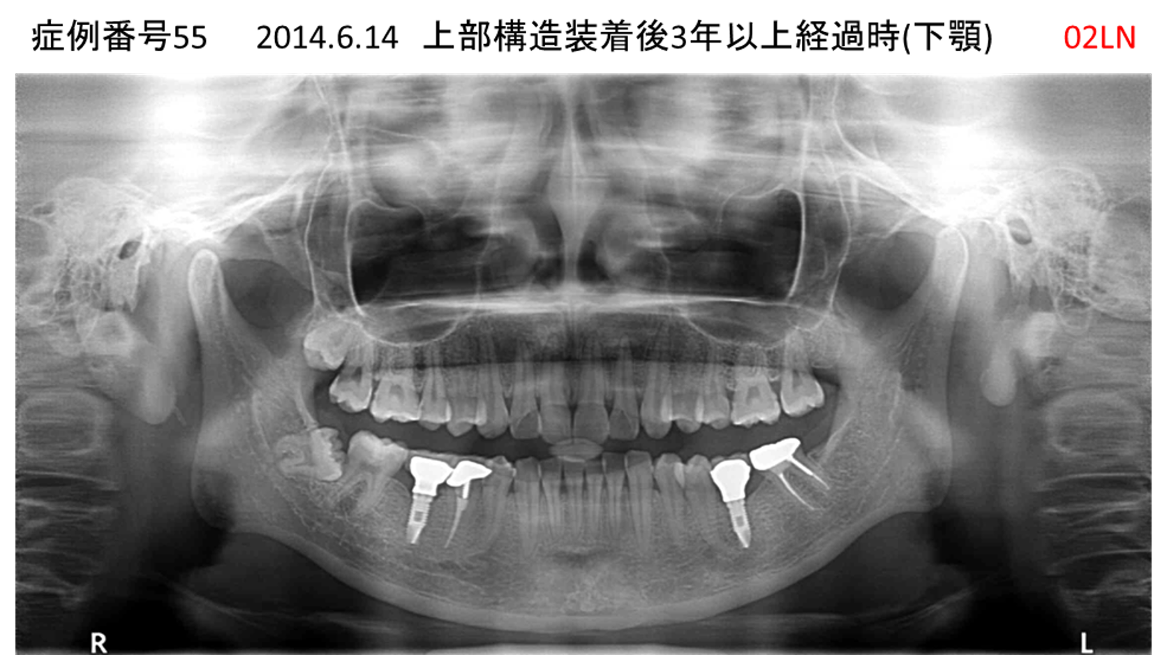 インプラント治療後
