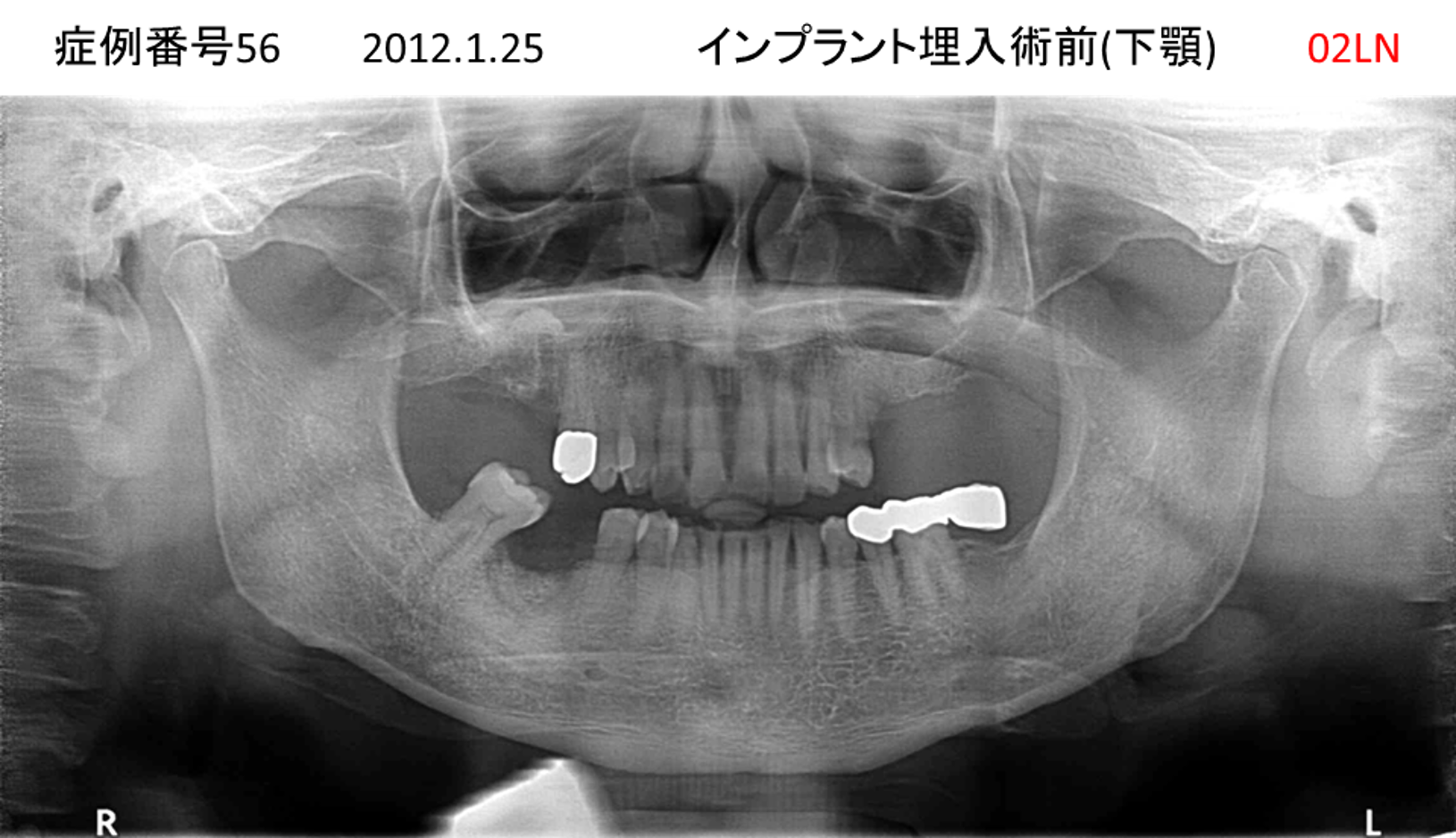 インプラント治療前