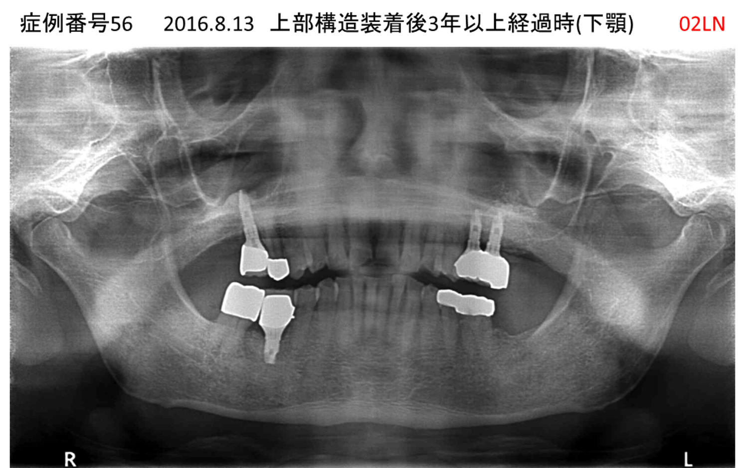 インプラント治療後